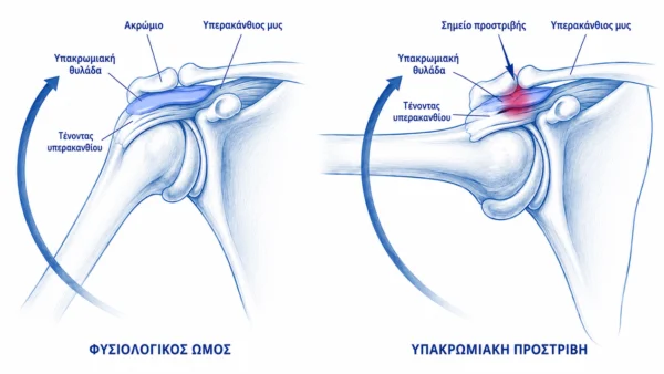 Υπακρωμιακή πρόσκρουση του τένοντα του υπερακανθίου